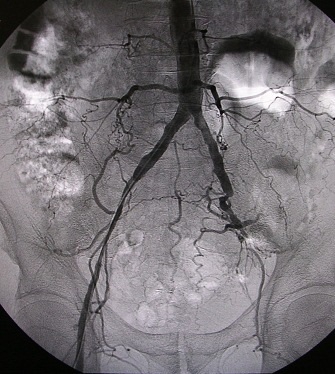 Рис.1.Окклюзия наружной подвздошной артерии слева