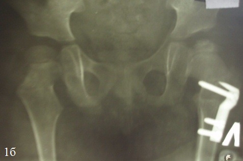 Рис. 1. Рентгенограммы больной М. до операции и в ближайшем периоде после операции