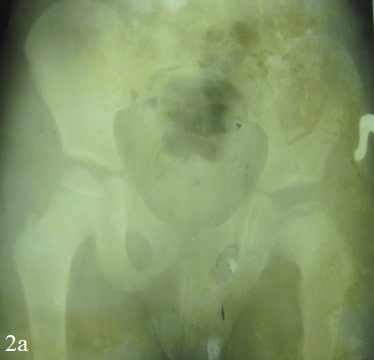 Рис. 2. Фото и рентгенограммы больного Т., 5 лет, до операции, в процессе лечения и в отдалённый период после операции