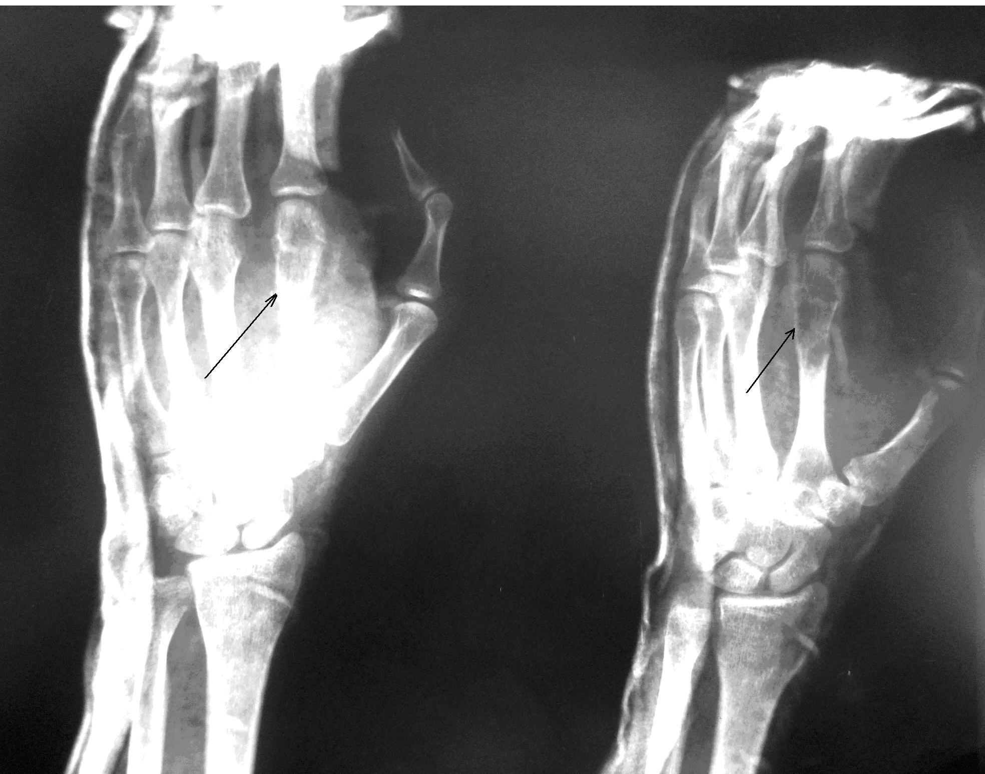 Рис. 1. б) Рентгенограмма левой кисти в прямой и боковой проекциях больной Д. после оперативного лечения спустя 3 дня, в гипсовой лонгете (стрелками указана зона экскохлеации).