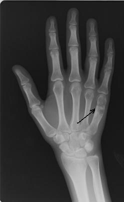 Рис.2. а) Рентгенограмма левой кисти в прямой проекции больной Я. до оперативного лечения (стрелками указана энхондрома V пястной кости).