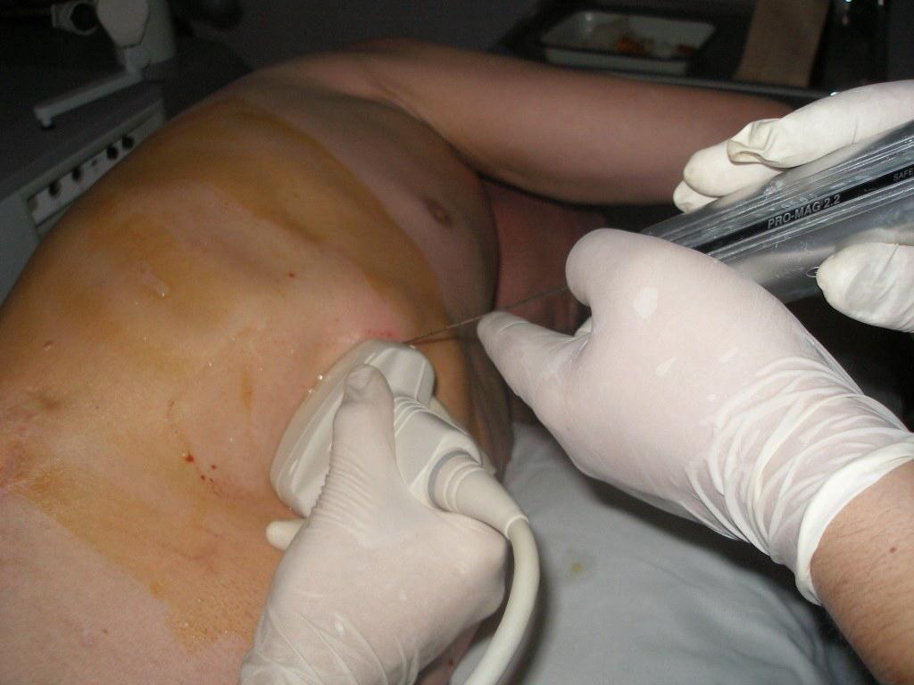 Рис. 3. Пункционная биопсия объемного образования печени. Проведение пункционной иглы в ткань печени аналогично проведению УДПО и выполняется методом «свободной руки».