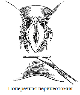 Рис. 2. Схематические изображения операции при ректоцеле.