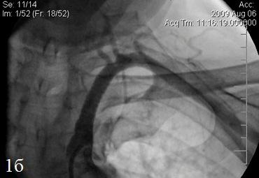 Рис. 1. а) Окклюзия левой подключичной артерии, состояние до стентирования; б) состояние левой подключичной артерии после стентирования, проходимость полностью восстановлена.
