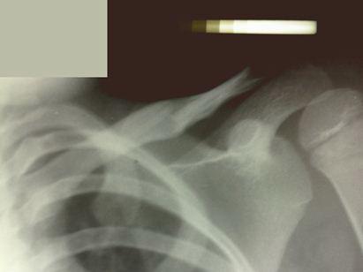Рис. 3. Рентгенограмма места перелома пациентки Г. 9 лет на 35 сутки после травмы.