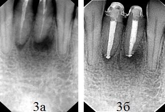 Рис. 3. Радиовизиограммы пациента контрольной группы 31, 41 зубов (до лечения и спустя двенадцать месяцев); а – периапикальное разрежение с четкими контурами (стрелка); замыкательные пластинки 31, 41 зубов – разрушены; б - определяется значительное уменьшение размеров перирадикулярных костных деструктивных очагов, прослеживается равномерная плотность заполнения корневых каналов пломбировочным материалом.