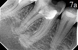 Рис. 7. Радиовизиограммы пациента основной группы 33, 34 зубов (до лечения и спустя двенадцать месяцев); а – четко визуализируется очаг деструкции костной ткани на наружной поверхности дистальной 1/3 корня 46 зуба, корневые каналы не заполнены пломбировочным материалом; б - определяется значительное уменьшение размеров перирадикулярных деструктивных очагов, формирование костно-трабекулярной структуры, обозначались зоны слияния очагов с окружающими тканями, нормализация ширины периодонтальной щели на всем протяжении.