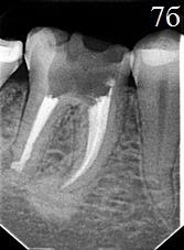Рис. 7. Радиовизиограммы пациента основной группы 33, 34 зубов (до лечения и спустя двенадцать месяцев); а – четко визуализируется очаг деструкции костной ткани на наружной поверхности дистальной 1/3 корня 46 зуба, корневые каналы не заполнены пломбировочным материалом; б - определяется значительное уменьшение размеров перирадикулярных деструктивных очагов, формирование костно-трабекулярной структуры, обозначались зоны слияния очагов с окружающими тканями, нормализация ширины периодонтальной щели на всем протяжении.