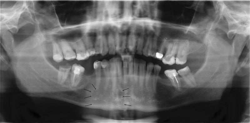Рис.1 Панорамная рентгенограмма больной К. (ХГП, средне-тяжелое течение). Стрелками показаны очаги остеопороза.