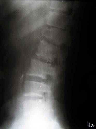 Рис. 1: а и б – рентгенограммы при госпитализации; в и г – после операции.