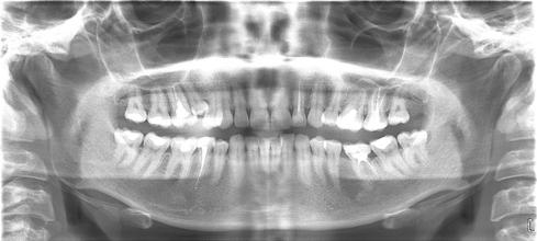 Рис. 1а. Ортопантомограмма. По данным ортопантомографии выявляется ретенция и дистопия зуба 1.5, однако проследить сохранность периодонтальной щели не представляется возможным (особенно в области корня).