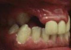 Рис. 4а. Фотография смыкания зубных рядов.