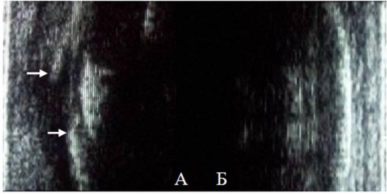 Рис. 4. Больной К., 32 г. Cонограммы передней стенок лобной пазухи справа (А) и слева (Б). Стрелками указаны кортикальные концы косных отломков, а между ними вдавленный костный фрагмент.
