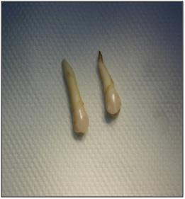 Рис. 1. Удаленные зубы, очищенные от кальцинированных зубных отложений и зубного налета.
