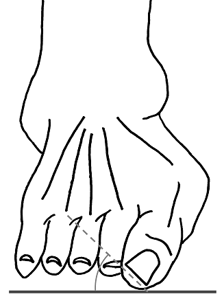 Рис. 5. Гиперпронация 1 пальца в условиях грубой вальгусной деформации 1 плюснефалангового сустава стопы.