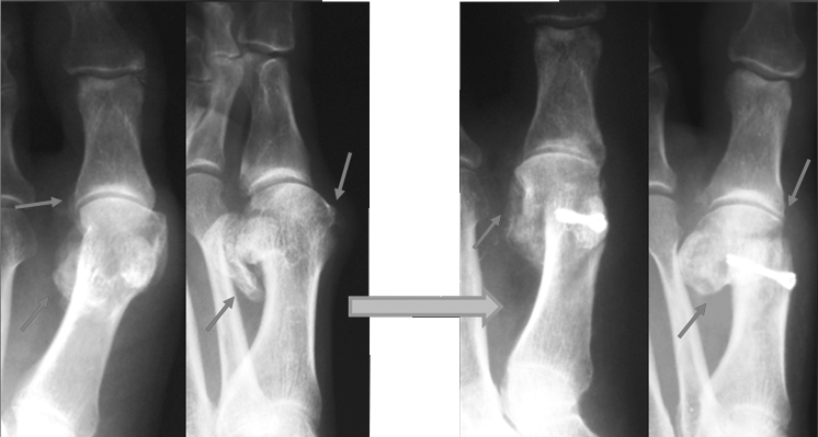 Рис. 9. Рентгенограммы стопы до и после хеилэктомии и дистальной L-образной остеотомии.