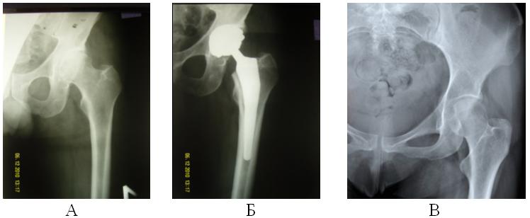 Рис. 1. А – Коксартроз 3 ст., Б – после эндопротезирования тазобедренного сустава, В – нормальный тазобедренный сустав.