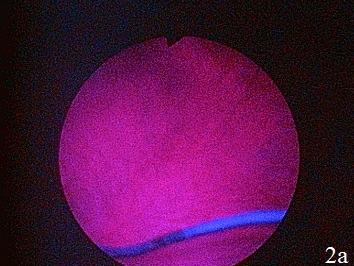 Рис. 2. а – цистоскопическкая картина при ФДД при внутрипузырном введении фотодитазина в дозе 50.0 мг - флуоресцентный муар, б – цистоскопическкая картина при ФДД при внутрипузырном введении фотодитазина в дозе 10.0 мг фотодитазина - отчетливая визуализация опухоли.