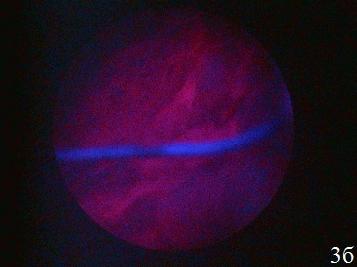 Рис. 3. Эндоскопическая картина при цистоскопии в белом свете (а) и при флуоресцентной цистоскопии (б). В зоне флуоресценции - переходноклеточный рак.
