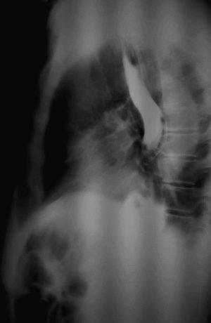 Рис. 2. Обзорная рентгенография органов брюшной полости и грудной клетки (боковая проекция). Барием заполнен пищеводно-тонкокишечный анастомоз и отводящая петля тонкой кишки.