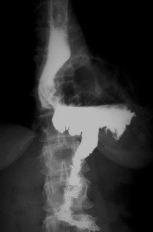 Рис. 5. Обзорная рентгенография органов брюшной полости и грудной клетки (прямая проекция). Барием заполнен обходной энтеро-энтероанастомоз на выключенной по Ру петле тонкой кишки.