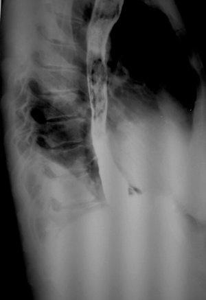 Рис. 6. Обзорная рентгенография органов брюшной полости и грудной клетки (боковая проекция). Барием заполнен обходной энтеро-энтероанастомоз на выключенной по Ру петле тонкой кишки.