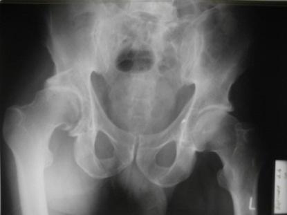 Рис. 2. Обзорная рентгенограмма костей таза где определяется перелом задней стенки ВВ с подвывихом головки бедра справа.