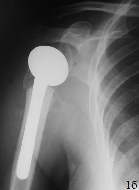 Рис. 1а. Пациентка С. 51 г., оскольчатый переломовывих проксимального отдела правой плечевой кости.