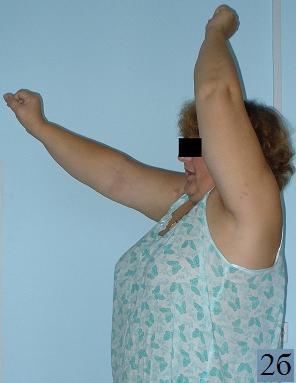 Рис. 2 а-в. Пациентка С. Функция плечевого сустава через 6 мес. после оперативного вмешательства. Наблюдается симптом «пожимание плеча» и ограничение внутренней ротации