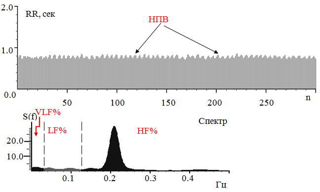 Рис. 3. РКГ пациента с СД 1 и НПВ в покое. Заметны волны из преобладающих низкоамплитудных удлинений в 3-5 межсистолических интервалов, их частота 0,23±0,045 Гц. Они имеют «пик» спектральной плотности на спектрограмме в высокочастотном диапазоне (HF,%)