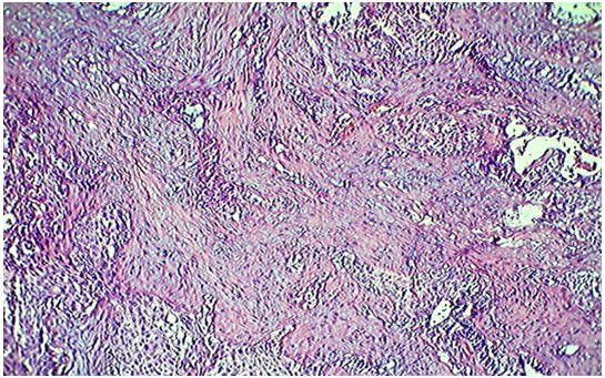 Рис. 2. Раковые железы среди крупных полей склероза с ослизнением. Окраска гематоксилином и эозином. Х 100