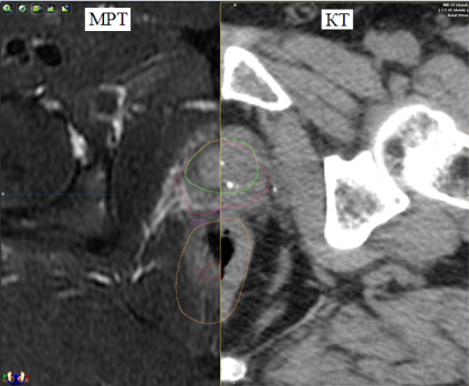 Представлены КТ и МРТ-срезы пациента. Наглядно видны различия в объёмах при оконтуривании предстательной железы (зелёный контур выполнен по данным МРТ, а красный – по данным КТ)