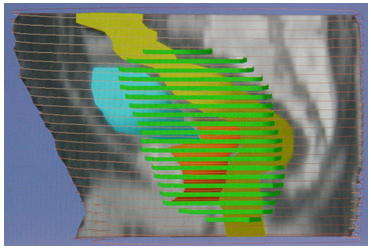  Изодозное распределение в сагиттальной плоскости объема лучевого воздействия на первичную опухоль и зоны регионарного метастазирования при конформной (3D CRT)ЛТ
