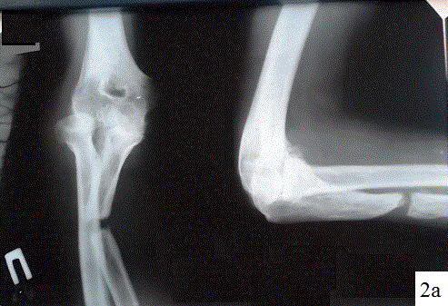 Рис. 2. Рентгенограммы больного У.У.: а – при поступлении, ложный сустав верхней трети локтевой кости справа;