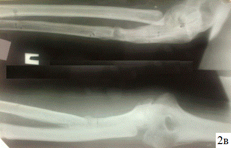Рис. 2. Рентгенограммы больного У.У.: в – после удаления аппарата Илизарова