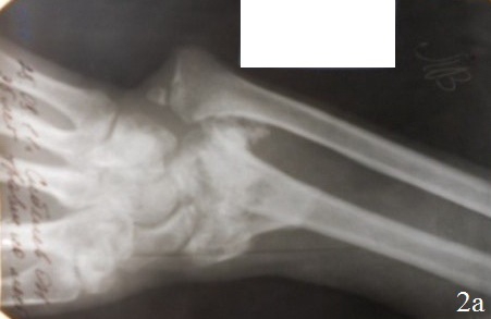 Рис. 2. Рентгенограммы кистевого сустава больного С., 37 лет: а - до операции, б – во время первого этапа операции, в - после остеосинтеза