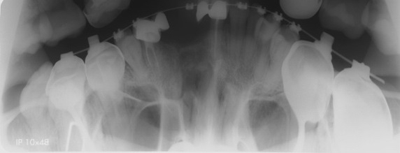 Рис. 4. Панорамная микрофокусная рентгенография верхней челюсти с увеличением пациента с врожденной правосторонней расщелиной альвеолярного отростка. Через год после костно-пластической операции. Зона регенерата определяется в виде участка разрежения костной ткани с нечеткими неровными контурами, с четко прослеживаемой полосой просветления на границе с окружающей костной тканью