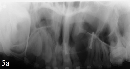 Рис. 5а. Врожденная двухсторонняя расщелина альвеолярного отростка. Панорамная микрофокусная рентгенография верхней челюсти с увеличением - область щелевидной расщелины между зубами 1.3, 1.2 не видна