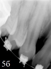 Рис. 5б. Врожденная двухсторонняя расщелина альвеолярного отростка. Микрофокусная прицельная рентгенография - между зубами 1.3, 1.2 определятся щелевидный дефект с четкими ровными контурами