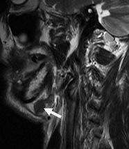 Рис. 12. Пациент П., 68 лет. МРТ полости рта, ротоглотки в коронарной проекции. Выявляется увеличенный подчелюстной лимфатический узел округлой формы, неоднородной структуры (стрелки)