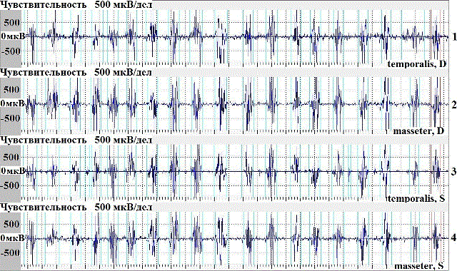 Рис. 2. Электромиограмма испытуемой С., 36 лет при жевании 0,8 г сушеного миндаля в течение 15 с. 1-temporalis,D; 2-masseter,D; 3-temporalis, S; 4-masseter, S. Чувствительность 500 мкВ/дел.