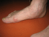 Рис. 2. Вид сбоку плосковальгусной стопы с дисфункцией сухожилия задней большеберцовой мышцы (СЗБМ).