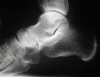 Рис. 3. Рентгенограмма латеральной проекции стопы – артроз таранноладьевидного сустава с сужением суставной щели.