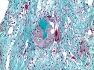 Рис. 4б. Резорбция гигантскими клетками инородных тел гранул остеопластическго материала, располагающегося в незрелой соединительной ткани. Окраска по Массон-Голднер. Х200
