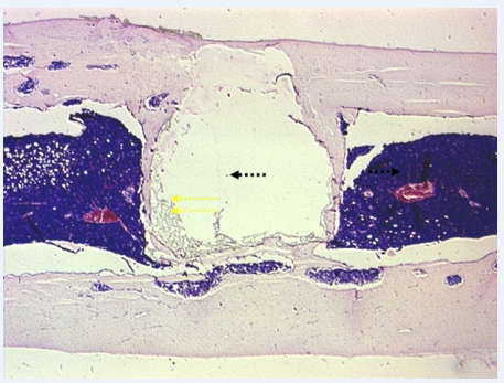 Рис. 1. Группа 1, 6 месяцев опыта. В результате ремоделирования пласт новообразованной костной ткани (одинарные стрелки) у имплантата суживается. За его пределами виден восстановившийся красный костный мозг (сдвоенные стрелки). x25