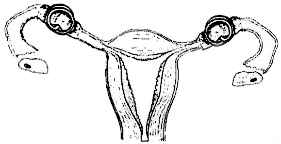 Рис. 3. Схема наложенных на маточные трубы кольцевидных клемм