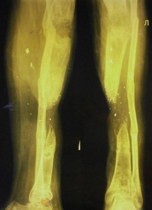 Рис. 3. Рентгенография левой голени в 2-х проекциях пациента после демонтажа аппарата
