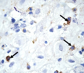 Рис. 1. CD68-позитивные клетки (указаны стрелками) в базальной децидуальной оболочке при инфицировании Chlamydia trachomatis в персистентной форме. Беременность 6-8 недель. Иммуногистохимическое окрашивание, гематоксилин. Увел. 900
