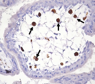 Рис. 2. CD68-позитивные клетки (указаны стрелками) в строме ворсины хориона. Инфицирование половых путей Chlamydia trachomatis в персистентной форме. Беременность 6-8 недель. Иммуногистохимическое окрашивание, гематоксилин. Увел. 400