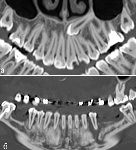 Рис. 3. КТ. а - криволинейная реконструкция (curved-MPR) верхней челюсти. Пациентка Э., 24 года с врожденной зубочелюстной аномалией. Определяется дистопированный ретенированный зуб у корней 21-24 зубов. б - криволинейная реконструкции (curved-MPR) нижней челюсти. Пациентка М., 25 лет, с врожденной зубочелюстной аномалией. Определяется частичная вторичная адентия